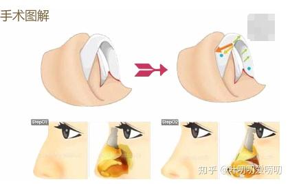 驼峰鼻矫正手术疼吗（驼峰鼻手术痛吗）